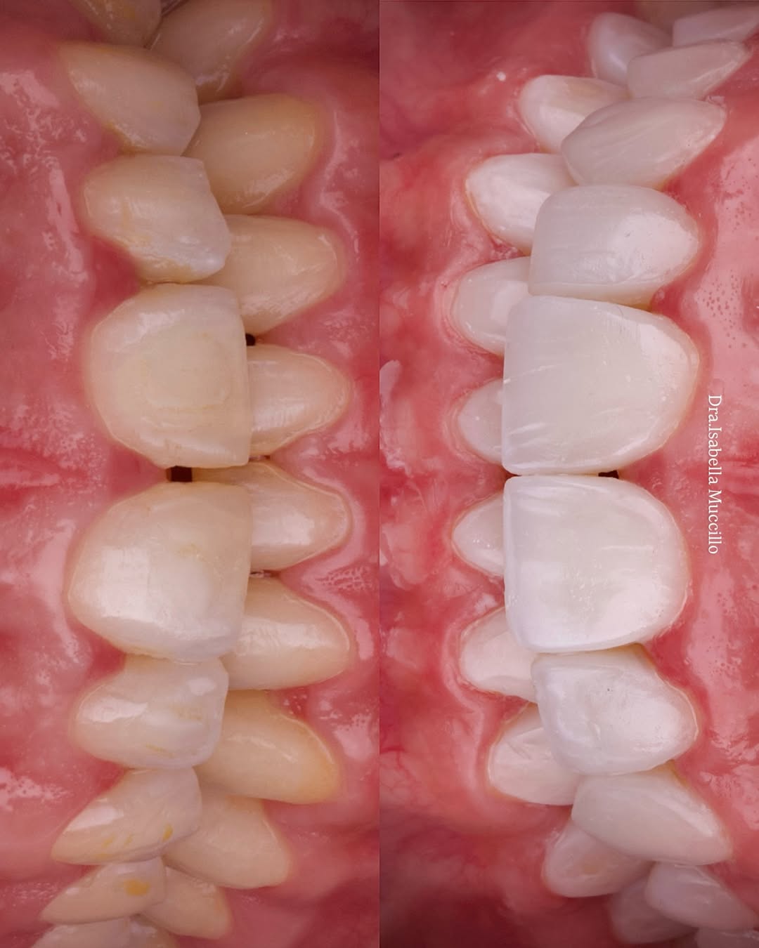 Naturalidade e Clareamento (antes e depois)